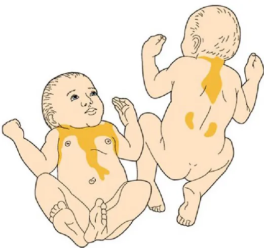 Figura  4:  Distribuzione  del  tessuto  adiposo  bruno  nel  neonato,  localizzato  tra  le 