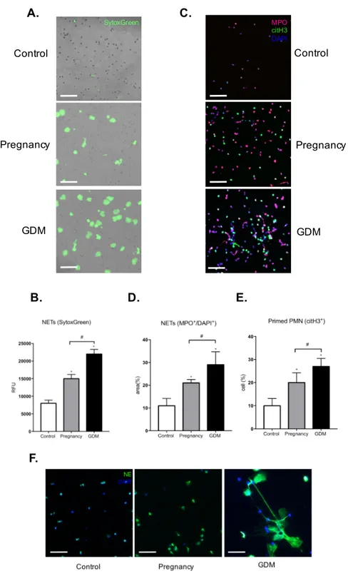 Fig.	 3.	 Neutrophils	 from	 GDM	 women	 exhibit	 excessive	 NET	 formation	 (A)	 Assessment	 of	
