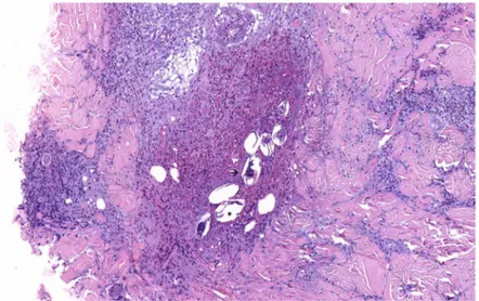 Fig 2. Pathological image. Dermal inflammatory infiltrates composed of lymphocytes, eosinophils, and