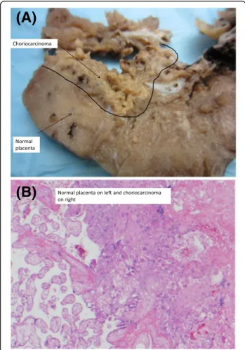 Fig. 1 Pathology of intraplacental choriocarcinoma. a Gross morphology of choriocarcinoma within the normal placenta