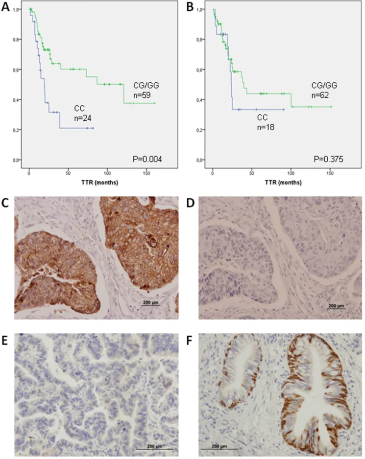 Figure 3. TTR according to KRT81 rs3660 genotype in the main histological subgroups and Immunohistochemistry analysis of KRT81 protein