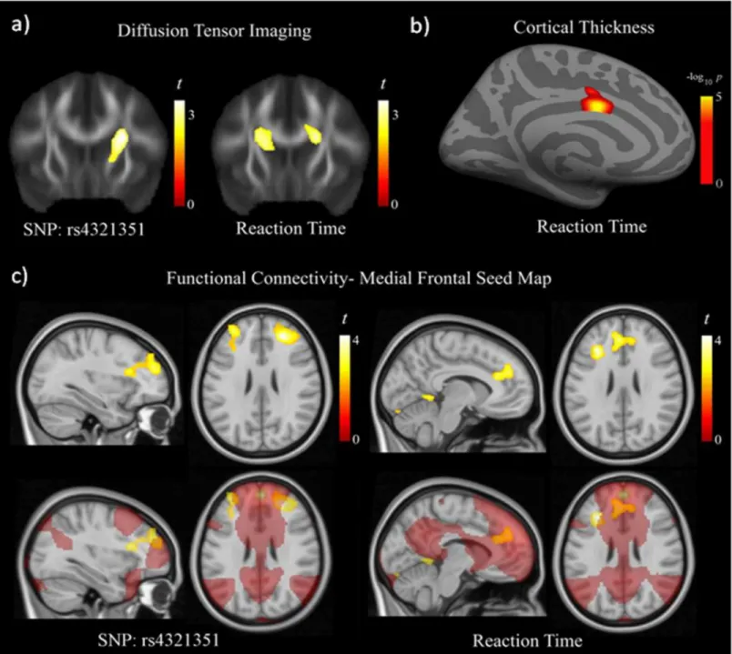 Fig 3. Diffusion tensor imaging results showed significantly lower fractional anisotropy (FA) in the region of the basal ganglia as a function of the G allele copies of the rs4321351 (a, left image)