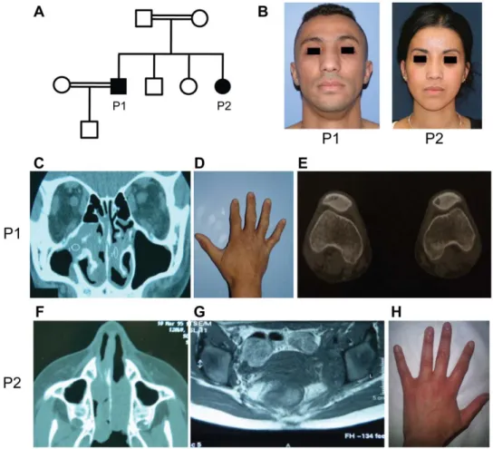 Figure 1. Clinical and radiological data of the patients P1 and P2. (A) Pedigree of the family