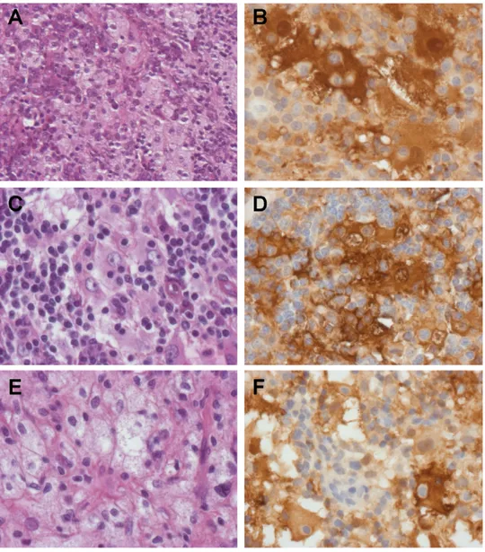 Figure 2. Histology of nasal (A, B, F) and skin (C, D, E) biopsy specimens from P1 (A–E) and P2 (F)