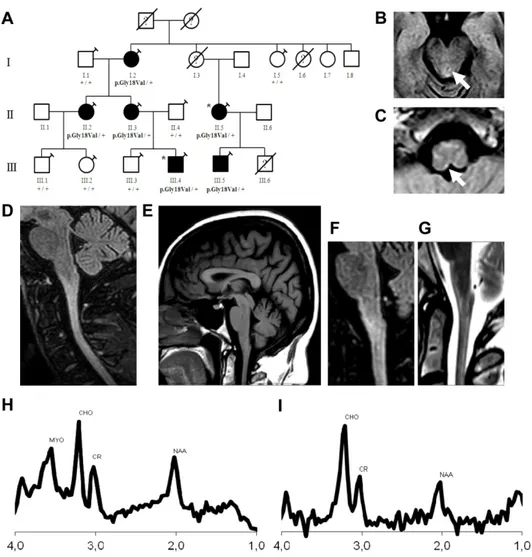 Figure 1: Family tree and genotype data for the p.Gly18Val variant and brain and cervical MRI and MRS of  patients II.3 and II:2