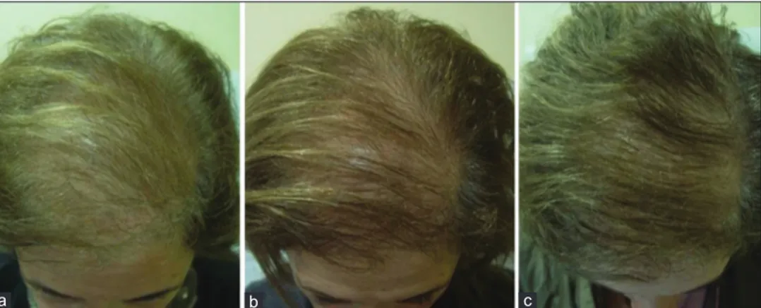 Figure 2:   (a)  A  33-year-old  male  with  male  androgenetic  alopecia  Ebling II, (b) showing improvement after 3 sessions of treatment
