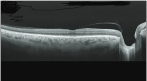 Figure 1: Horizontal image with swept-source OCT at the foveal level showing posterior vitreous detachment, which remains adhered to the fovea and the papillary edge.