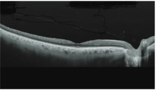 Figure 2: Study of the retinal surface with swept-source OCT showing posterior vitreous detachment, which remains attached at the papillary level.