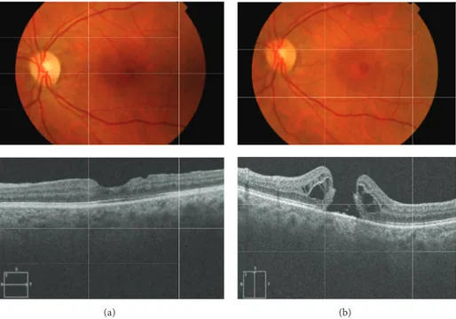 Figure 4: (a) Fundus photography and OCT of a patient who underwent macular hole surgery with ILM peeling and adequate reconstitution of the outer retina (ELM and ellipsoid bands) and visual acuity 20/30