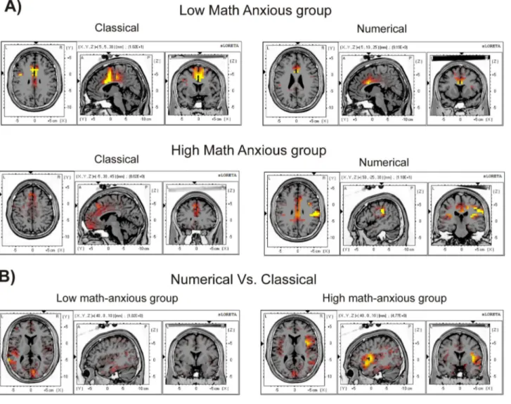 Figure  5.    Images  of  neural  activity  computed  with  sLORETA.    The  images  represent  cortical  areas  showing  significant
