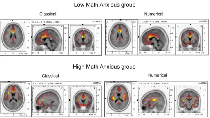 Figure  6.    Images  of  neural  activity  computed  with  sLORETA.    The  images  represent  cortical  areas  showing  significant