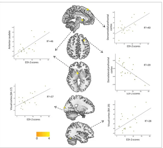 Fig 4. Associations between EDI-2 scores and brain activity in AN patients during rejection feedback