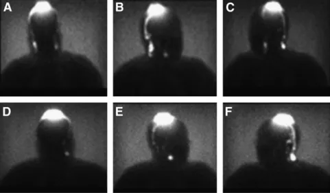 FIGURE 2. Discordance between first (A– C) and second (D–F) lymphoscintigraphy studies of 53-y-old woman with melanoma on central frontoparietal area