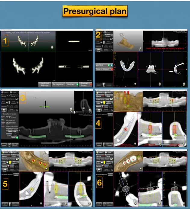 Figure 9. Presurgical plan using the Navident® planning tool. (1) Registration of the fiducials 