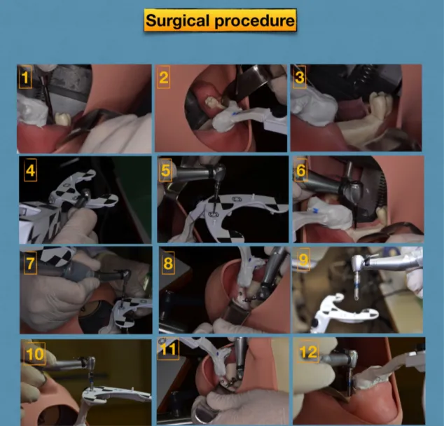 Figure  13.  Surgical  procedure.  (1)  Crestal  incision  with  a  type  15C  scalpel  blade