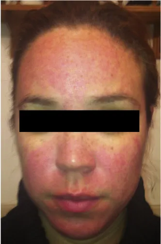 Fig 2. Rosacea, patient 1. Twelve hours after application of brimonidine tartrate to forehead, cheeks, nose, and chin