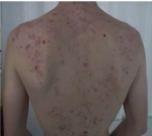 Fig 1. Acne fulminans. Initial presentation with draining pustules and crusted papules and nodules on the back.J AMACADDERMATOL