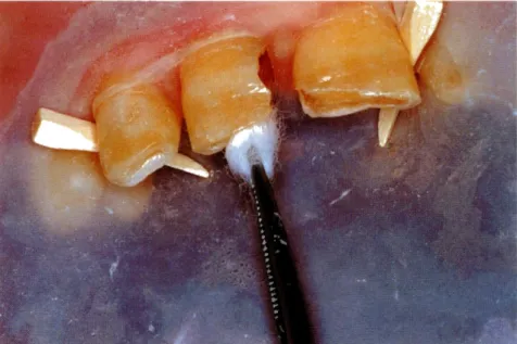 Figura 4.  Desinfección de  la  cavidad con  clorhexidina. 