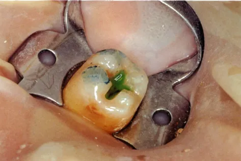 Figura  6  (superior).  Fotografía  del molar  con ácido,  previo al lavado.  Figura  7 (inferior)
