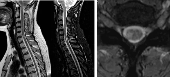 Figure 5. Spinal demyelinating lesion in Multiple Sclerosis patient. 