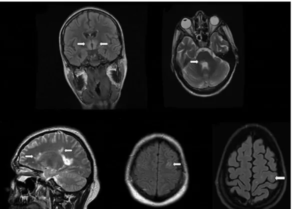 Figure 8. Brain MRI findings in Neuromyelitis optic patients 