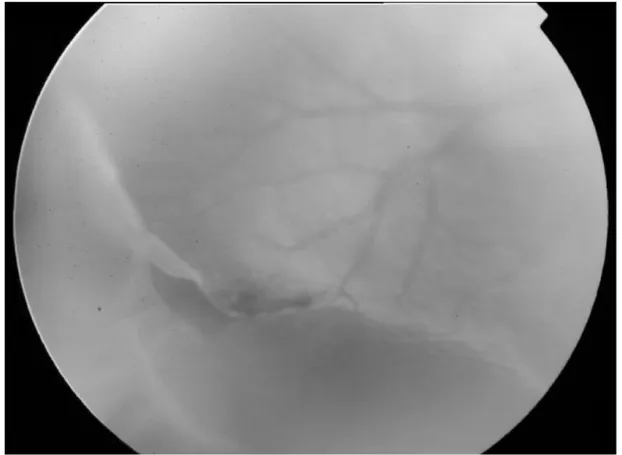 Figure 2B Fundus photograph showing a retinal tear next to a lattice degeneration.