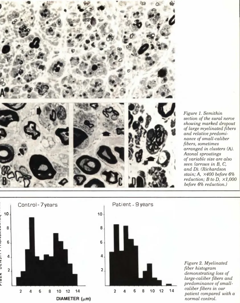 Figure l. Semithin  section of the sural nerve  showing marked dropout  of large myelinated fibers  and relative predomi­ nance of small-caliber  fibers, sometimes  arranged in clusters  (A)
