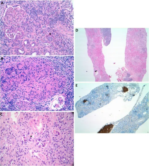 Figure 1. Light microscopy images illustrating acute interstitial nephritis cases with characteristic features