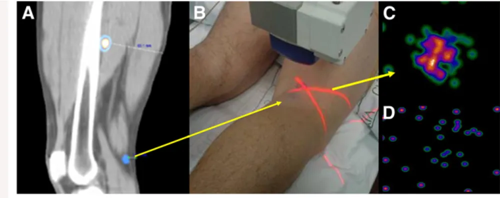 FIGURE 1. Patient with malignant melanoma on right heel. Preoperative lymphoscintigraphy showed lymphatic channels toward mid thigh and inguinal region