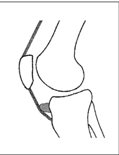 Fig. 26.- Método de adelantamiento del tendón rotuliano interponiendo un injerto óseo entre éste y la epífisis tibial