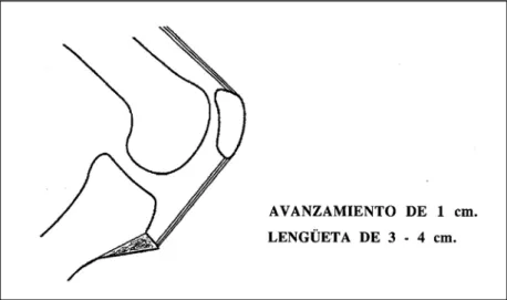 Fig. 31.- Esquema de la técnica de Bandi para lograr el adelantamiento de 1cm. del tendón rotuliano, con una osteotomía más corta  en la T.T.A