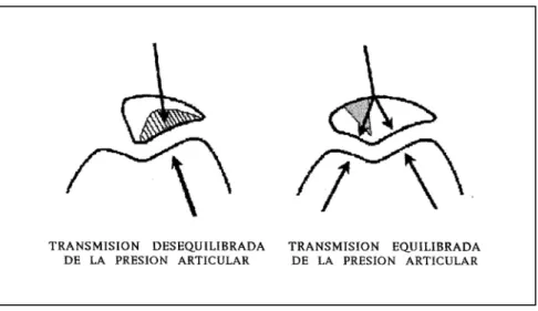 Fig. 35.- La ostectomia de apertura provoca el equilibrio en la transmisión de la presión en ambas facetas rotulianas, porque hace contactar la  faceta interna con la vertiente troclear correspondiente
