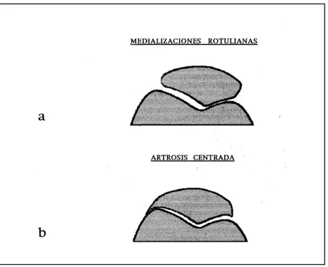 Fig. 44b.- Esquema de las distintas situaciones de la rótula en el D.F.P. a) medialización rotuliana por incongruencia  o hiperfricción
