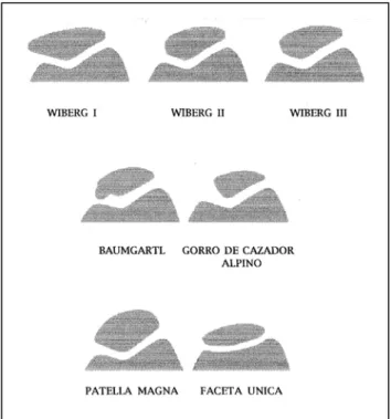 Fig. 46.- Esquema de las distintas variaciones en la morfología rotuliana. El tipo Wiberg II, es considerado como  estadisticamente normal