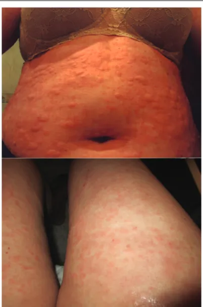 Figure 2. Patient 2: Clinical images of a 52-year-old Hispanic man with persistent pruritic papules and plaques with ﬂagellate erythema-type appearance at disease onset.Figure 1