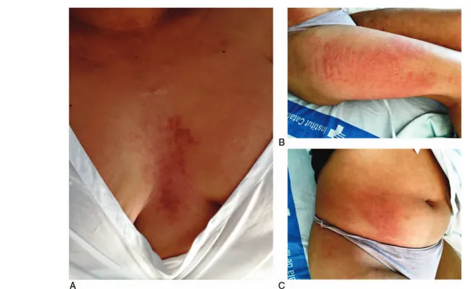Figure 3. Patient 3: Clinical images of a 29-year-old Hispanic woman who developed persistent pruritic plaques on the chest (A) and concomitant evanescent urticarial rash with intermittent high spiking fevers (B and C) during a disease ﬂare 29 months after