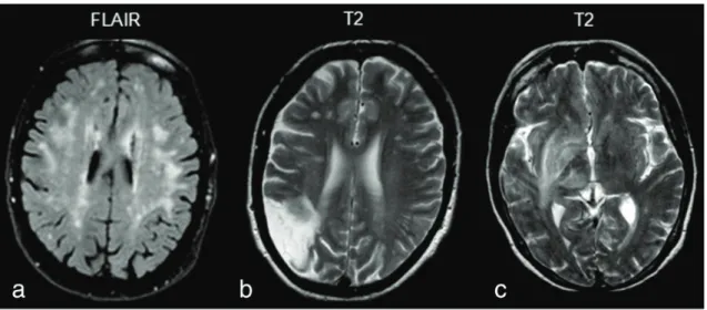 Figura 1: Imágenes de RM cerebral mostrando las lesiones descritas en el LES  neuropsiquiátrico