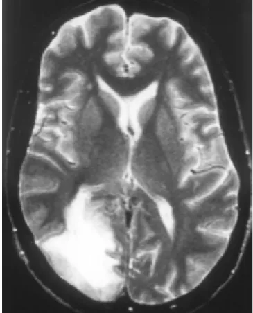 Figura 1. RMN de un paciente con enfermedad de Behçet que presentaba clínica de meningoencefalitis con hemianopsia homónima izquierda
