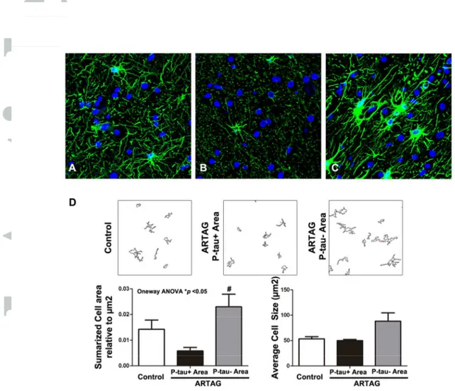 Figure 2: GFAP-immunoreactive astrocytes in white matter (A-D) (A) and ARTAG cases in TSAs-rich regions  (B) and neighboring regions without TSAs astrocytes (C)