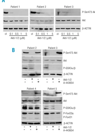 Figure 2.  Cytotoxic effect of Akt inhibitors on CLL cells and on peripheral blood lymphocytes (PBL) from healthy donors