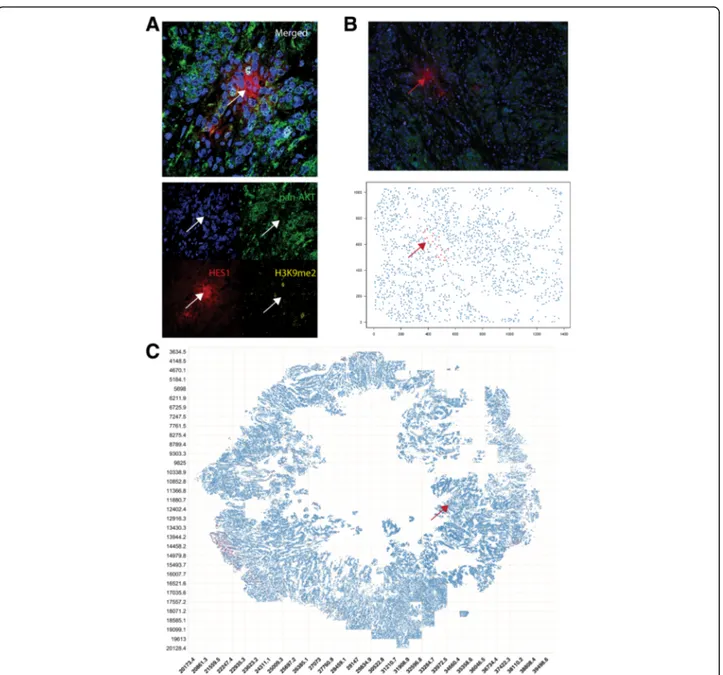 Fig. 2 AKT1 low quiescent cancer cells (QCCs) are found in primary breast tumor tissue using quantitative immunofluorescence microscopy