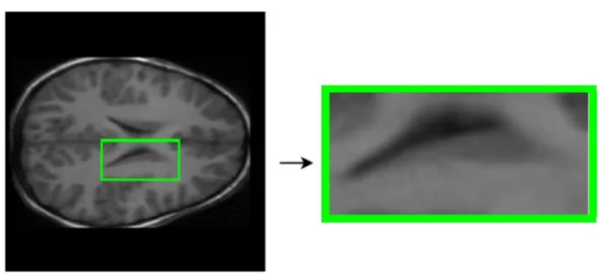 Figura 6) A la izquierda imagen original, en verde marcada el área que seguro contiene la totalidad del  núcleo   caudado,   coordenadas   obtenidas   mediante   segmentación   basada   en   atlas