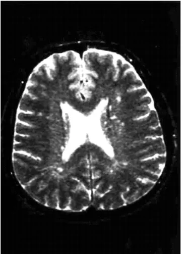 Figura 4.  Resonancia magnética cerebral en la que se observa una  ténue hiperseñal de la sustancia blanca periventricular e imágenes  nodulares hiperintensas en situación subcortical (secuencias  potenciadas en T2)