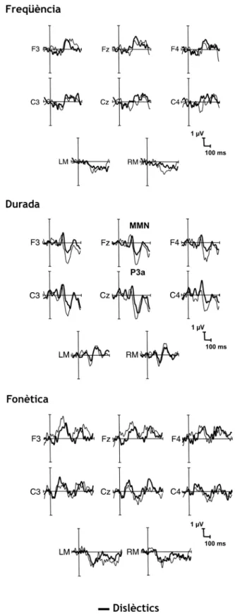 Figura 7. Ones diferència obtingudes amb la subtracció dels PECs elicitats davant els estímuls  estàndard dels obtinguts davant els estímuls discrepants, on s’observa el component MMN en la  condició de freqüència, durada i fonètica