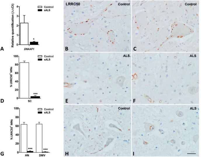 FIGURE 1. DNAAF1 and LRRC50 expression in human control and sALS lower motor neurons. (A) Reduced DNAAF1 mRNA expression in the anterior horn of the lumbar spinal cord in sALS compared with age-matched controls
