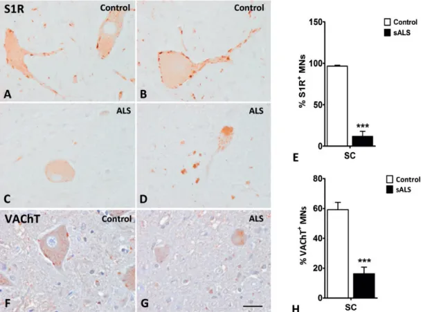 FIGURE 2. Sigma 1 receptor (S1R) and vesicular acetylcholine transporter (VAChT) immunoreactivity in motor neurons of the spinal cord in control and sALS