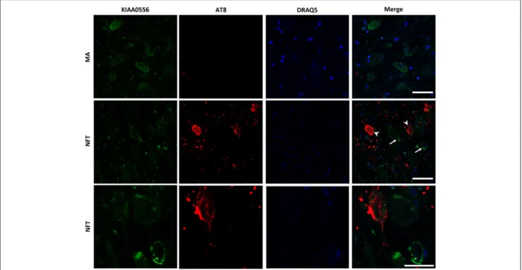 FIGURE 3 | Double-labeling immunofluorescence and confocal microscopy to KIAA0556 (green) and hyper-phosphorylated tau (clone AT8: red) in MA and in one case with NFT pathology stage IV