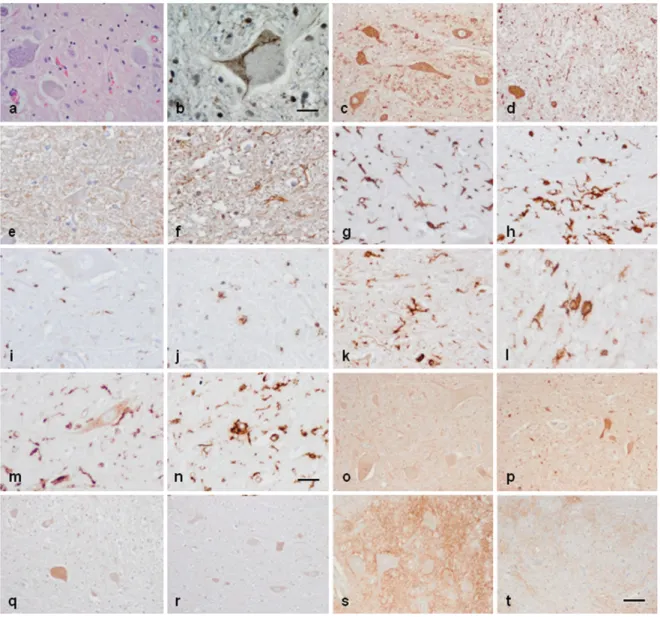 Figure  5.  Anterior  horn  of  the  spinal  cord.  Haematoxilin  and  eosin  staining  showing  damaged  neurons  in  ALS  (a).  Immuno‐ histochemistry to TDP‐43 showing skein‐like   intracytoplasmic inclusions (b), VDAC (c, d),  GFAP (e, f), IBA‐1 (g, h)