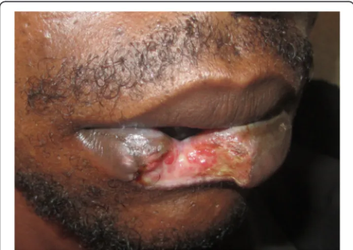 Figure 1 Clinical image: A human bite injury. Notice the severe lip tissue defect mimicking an ulcerative chronic process.