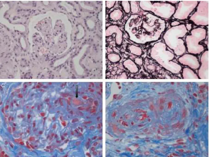 Fig. 1 – Renal histopathological lesions from haemolytic uraemic syndrome. (A) Ischaemic and retracted glomeruli